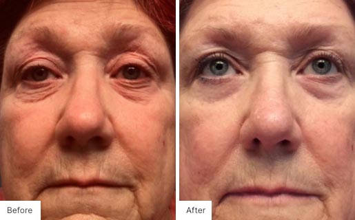 1- Before and After Real Results image for Age IQ Night Cream