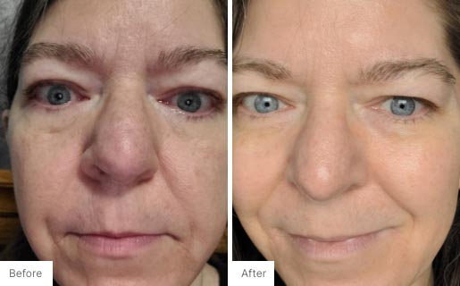 4 - Before and After Real Results photo of a woman's face.